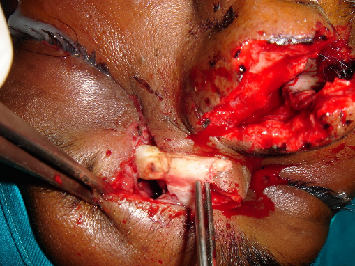 Tooth removed through the existing laceration in fronto-nasal region.