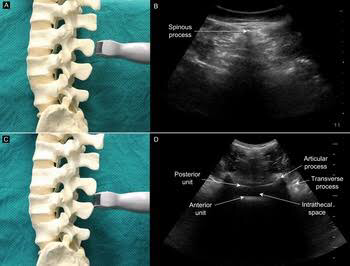 Ultrasound of spine. Ultrasound probe kept intransverse orientation at the level of spinous process (A) and corresponding image (C). Ultrasound probe kept in transverse orientation at the level of interspinous space (B) and corresponding image showing BAT sign (D)