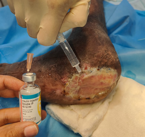 Topical application of insulin preparation