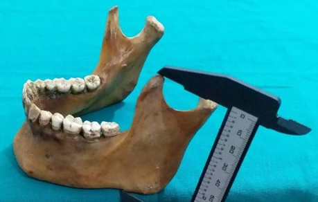 Showing measurement procedure for coronoid height