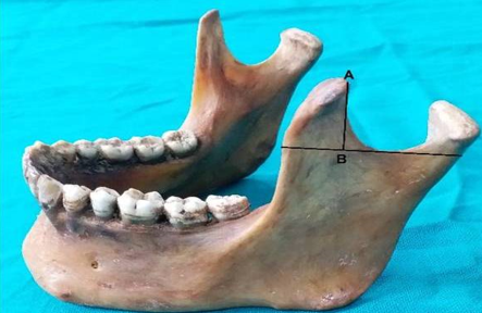 AB is length of coronoid process