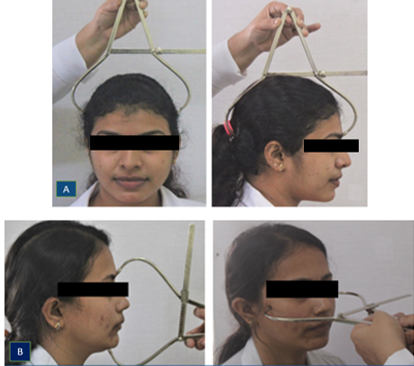 Measurement of headform (A) and face form (B) with standard spreading caliper
