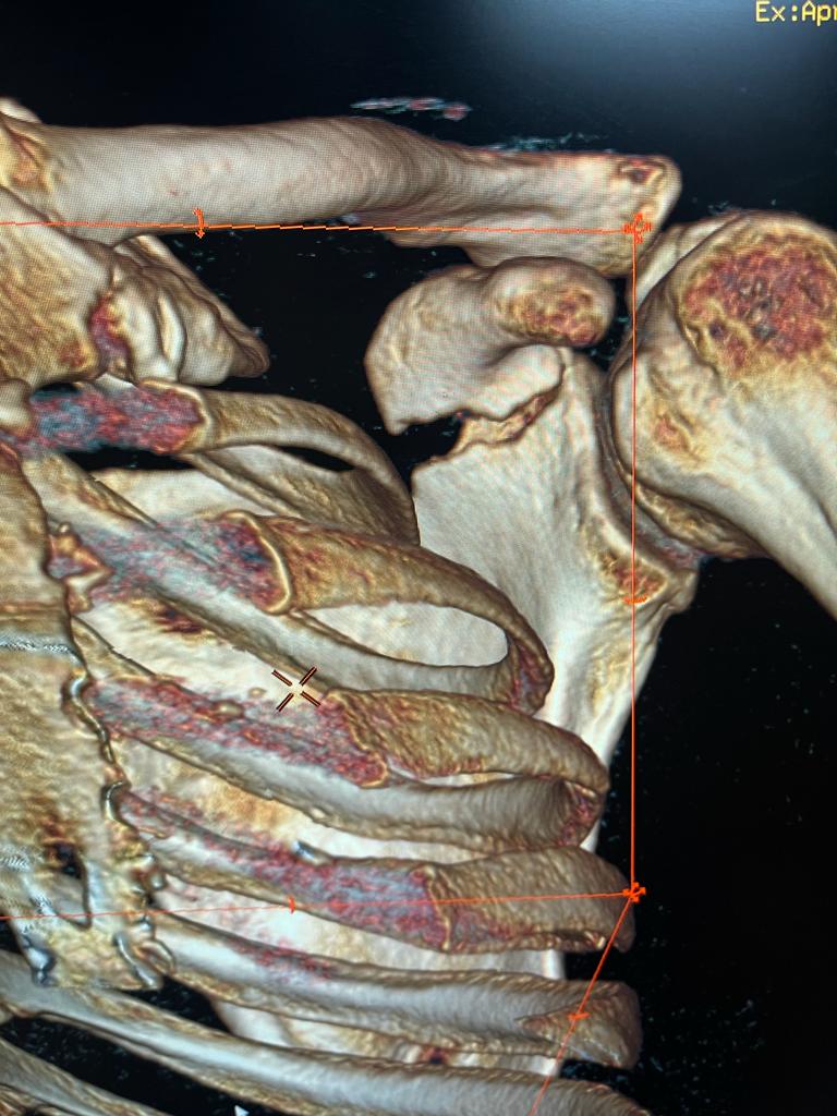 Fracture of coracoids with minimal displacement in 3D CT.