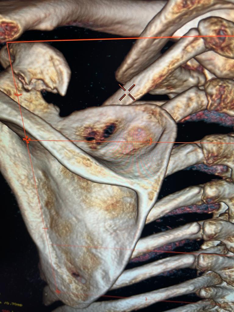 Fracture of coracoid posterior view in 3D CT