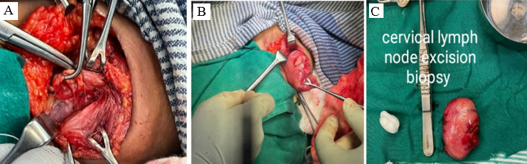 Excisional biopsy of neck mass by the transcervical route. 