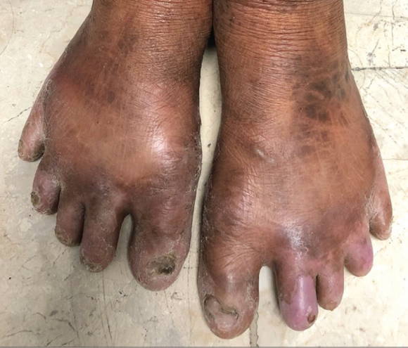 Hyperpigmented nodules, ulcerations, and deformities of the feet