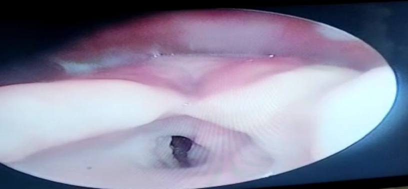 CT scan of the neck revealed thickened epiglottis, arytenoid, false folds, and aryepiglottic folds with 5 mm glottic chink. 