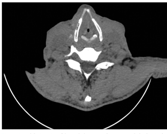 CT scan of the neck revealed thickened epiglottis, arytenoid, false folds, and aryepiglottic folds with 5 mm glottic chink. 