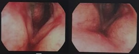 Flexible fibreoptic laryngoscopic examination showed a large and firm tumour, filling more than 50% of the subglottis site. It was pink with a distinct and marked vascular pattern over its capsule. 