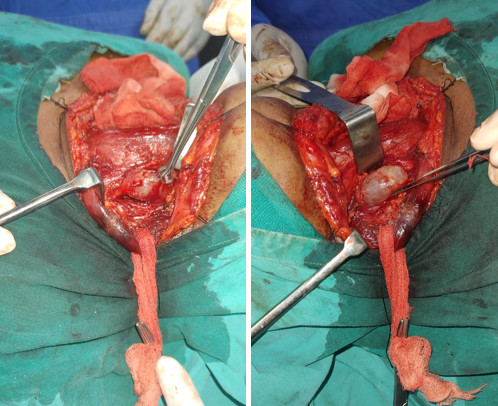 Intraoperative pictures-