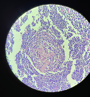 High power (40X) photomicrograph showing lollipop follicles, onion skin pattern