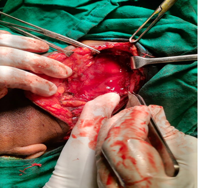 Intraoperative picture showing pus in the abscess cavity