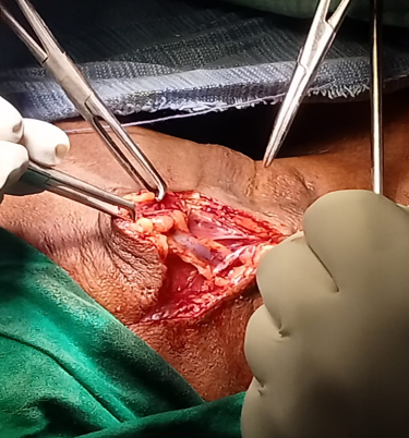 Selective neck dissection right cervical lymph node level II/III