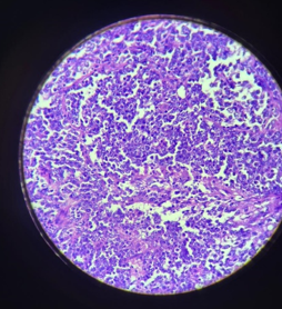 40X(high power) Photomicrograph exhibiting large- to Atypical medium-sized lymphocytes with nuclear atypia. 