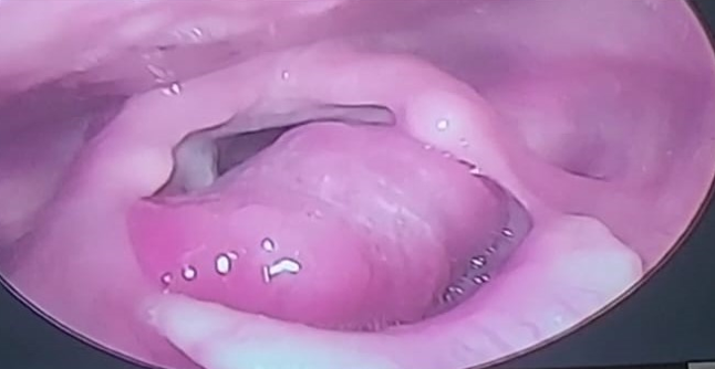 Flexible fibreoptic laryngoscopic picture showing a globular mass in the laryngeal surface of the Epiglottis