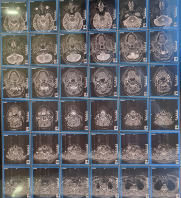 MRI neck (Plain) showing large lesion in the supraglottis. 