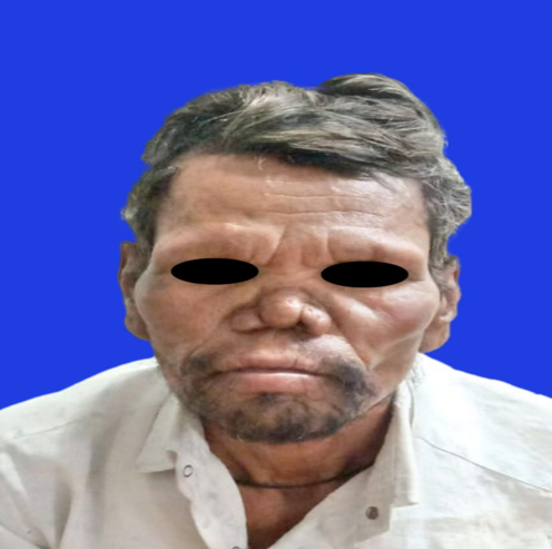 Leoninefacies with saddle nose deformity