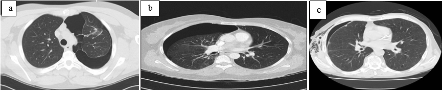 aand b: Pneumothorax; c: Subcutaneous emphysema