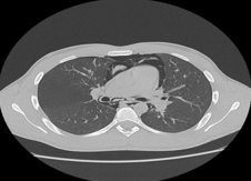 Pneumomediastinum