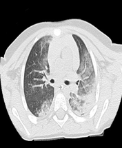 Lung contusion