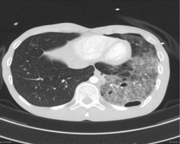 Lung laceration with contusion