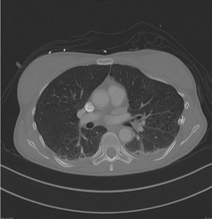 Rib fracture