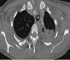 Scapula fracture
