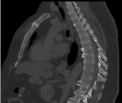 Sternum fracture