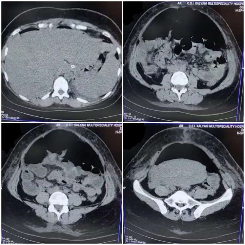 CT abdomen
