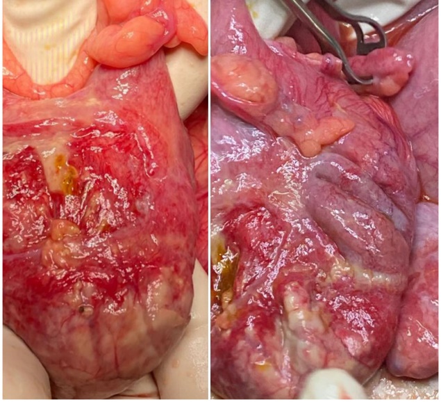Intra operative finding