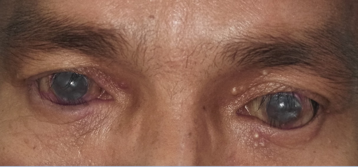 Entropion and Trichiasis of eyelids of both eyes seen in a case of SJS