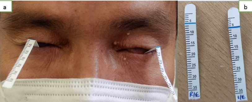 a; Schirmer’s test procedure performed, b; Schirmer’s test result showing no wettability at 5 minutes in both eyes,