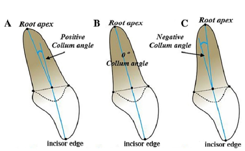 The diagrammatic depiction of collum angle in central incisor, (a) the long axis of root can deviate to labial side (b) coincidence with crown long axis (c) long axis of root can deviate to lingual side.