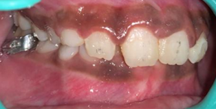 Brackets debonded-lateral view