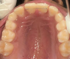 Fixed lingual retainer with 11, 21
