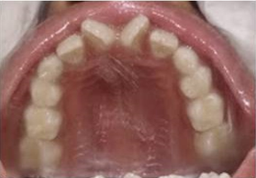 Palatal view-rotations with 11,21