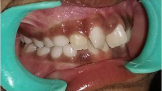 Right lateral intra-oral view