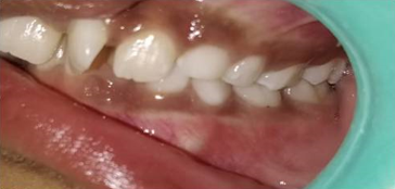 Left lateral intra-oral view