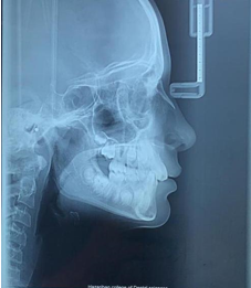 Lateral cephalogram