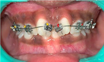 Roth 0.018 Brackets bonded- frontal view