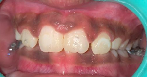 Brackets debonded-frontal view