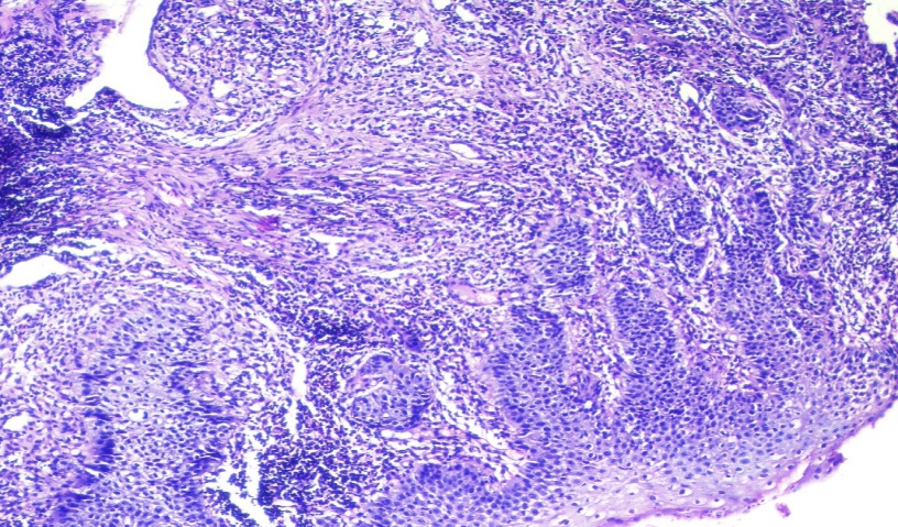 Tissue section shows markedly dysplastic and koilocytic changes in stratified squamous lining. Superficial stroma shows nests of dysplastic squamous cells and reactive desmoplasia with moderate lymphocytic inflammation. Hematoxylin and Eosin x10X.