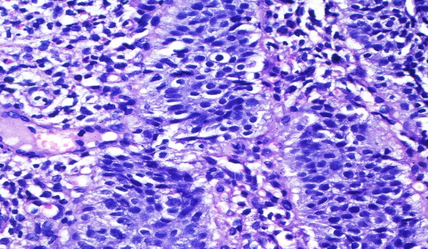 High power of Figure 1. Hematoxylin and Eosin x40X.