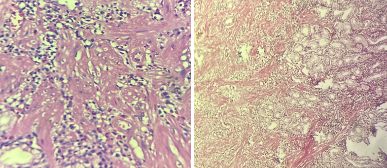40X100 showing glands within collagen Van Gieson stain positive for collagen