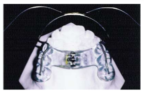 ModifiedThurow appliance
