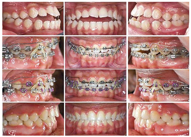 Application of elastics and an extrusion arch in the management of an open-bite malocclusion
