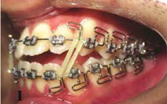 Multiloop edgewise archwire with vertical elastics