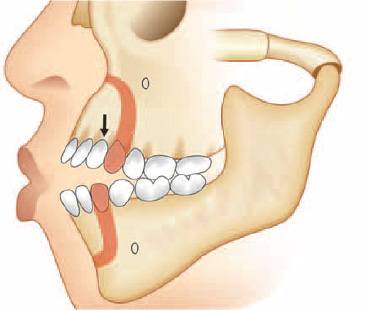 Anterior maxillary and mandibular sub apical osteotomy