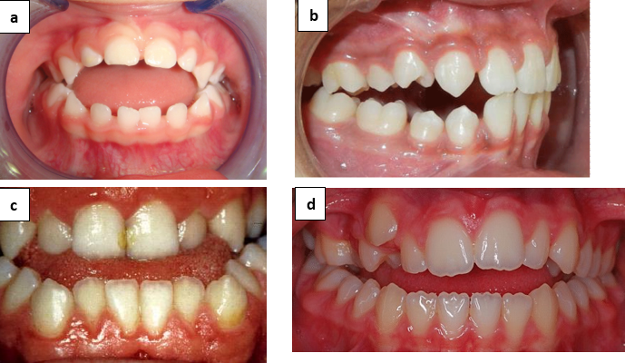 Rakosi classification of open bite