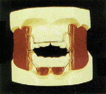 FR4 appliance for Open Bite